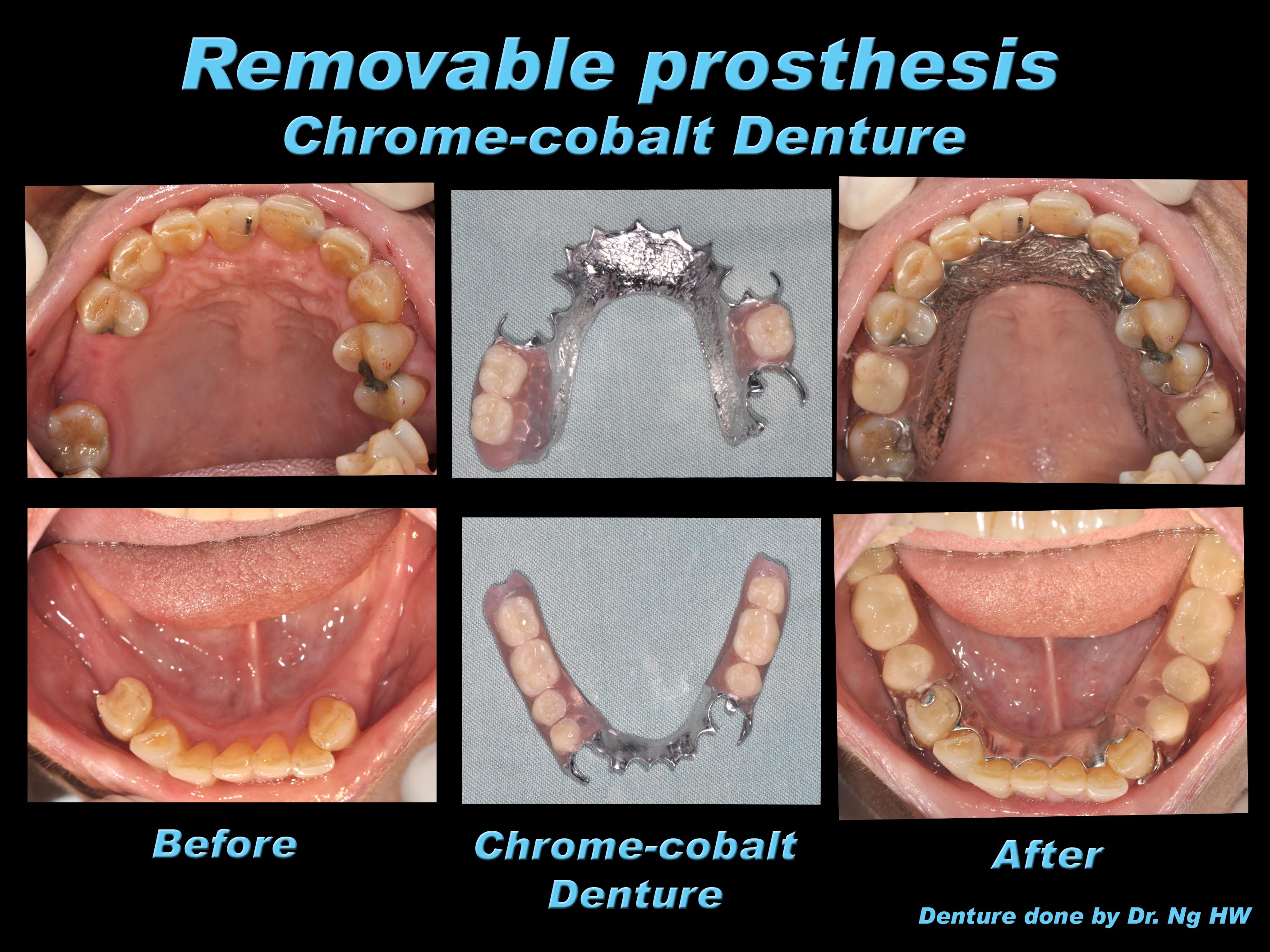 Flexible Denture Prestige dental care my