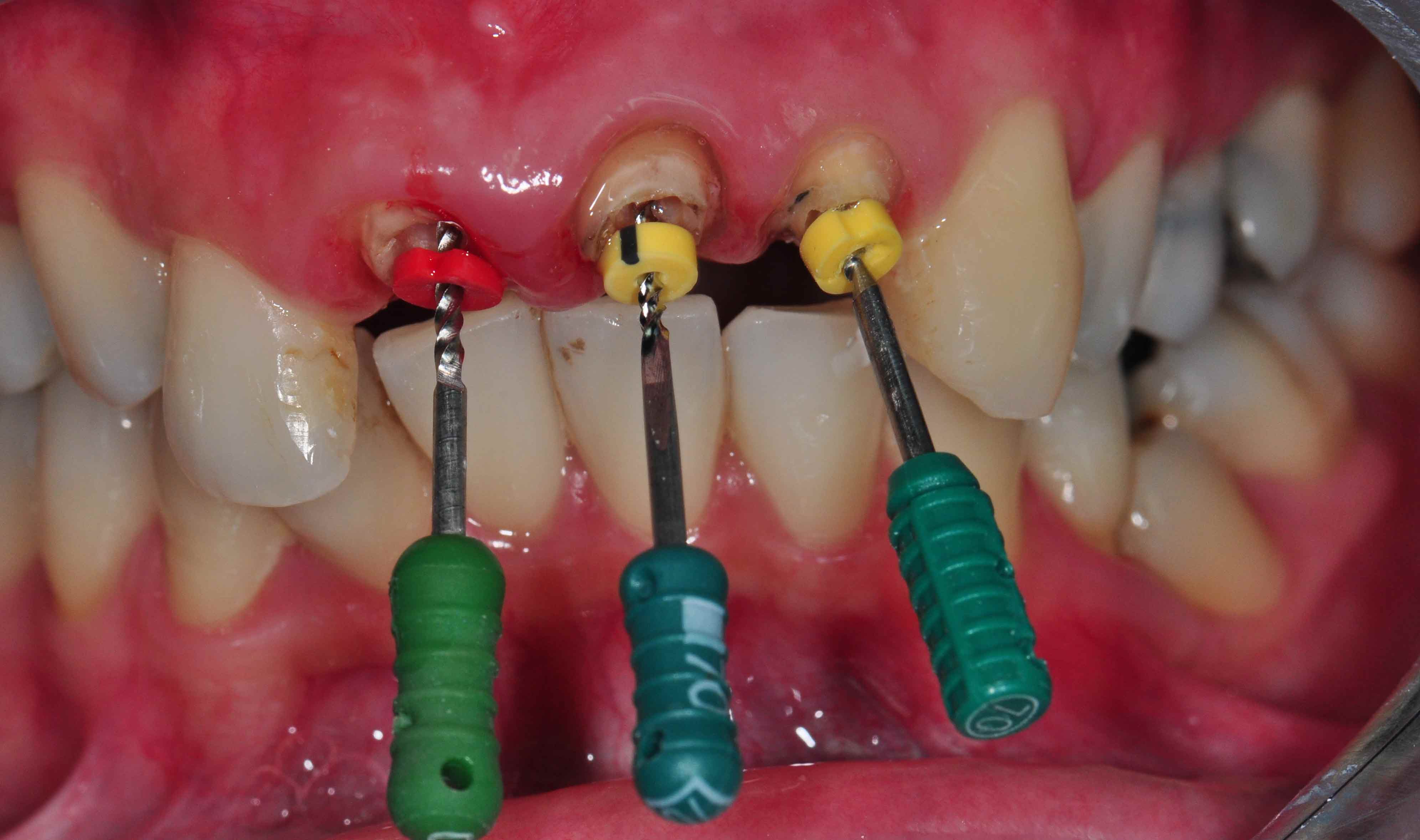 Front Tooth Root Canal