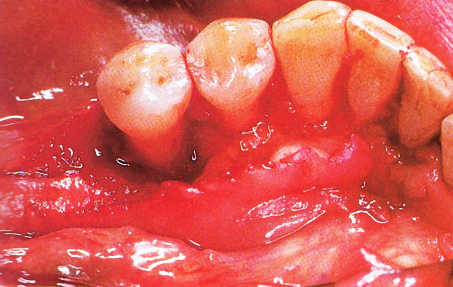 Moderate periodontitis. From Colour Atlas of Common Oral Disease